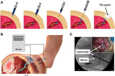 Augmented Transcutaneous Stimulation Using an Injectable Electrode: A Computational Study